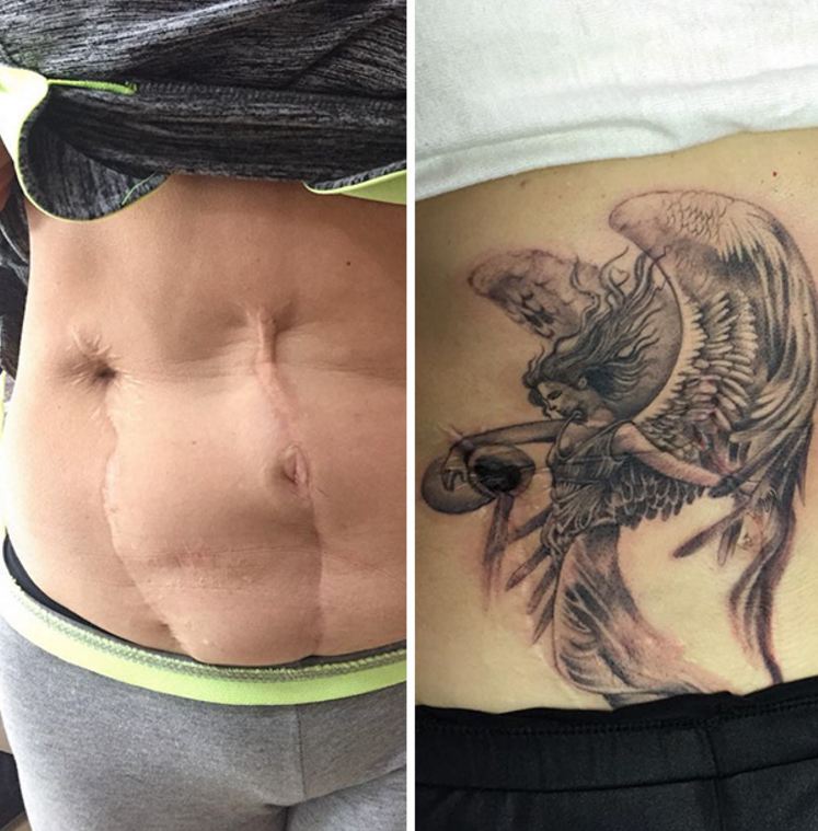 24 Amazing Tattoos That Turn Scars Into Works Of Art